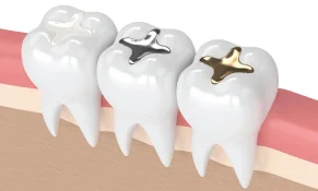 Teeth Filling