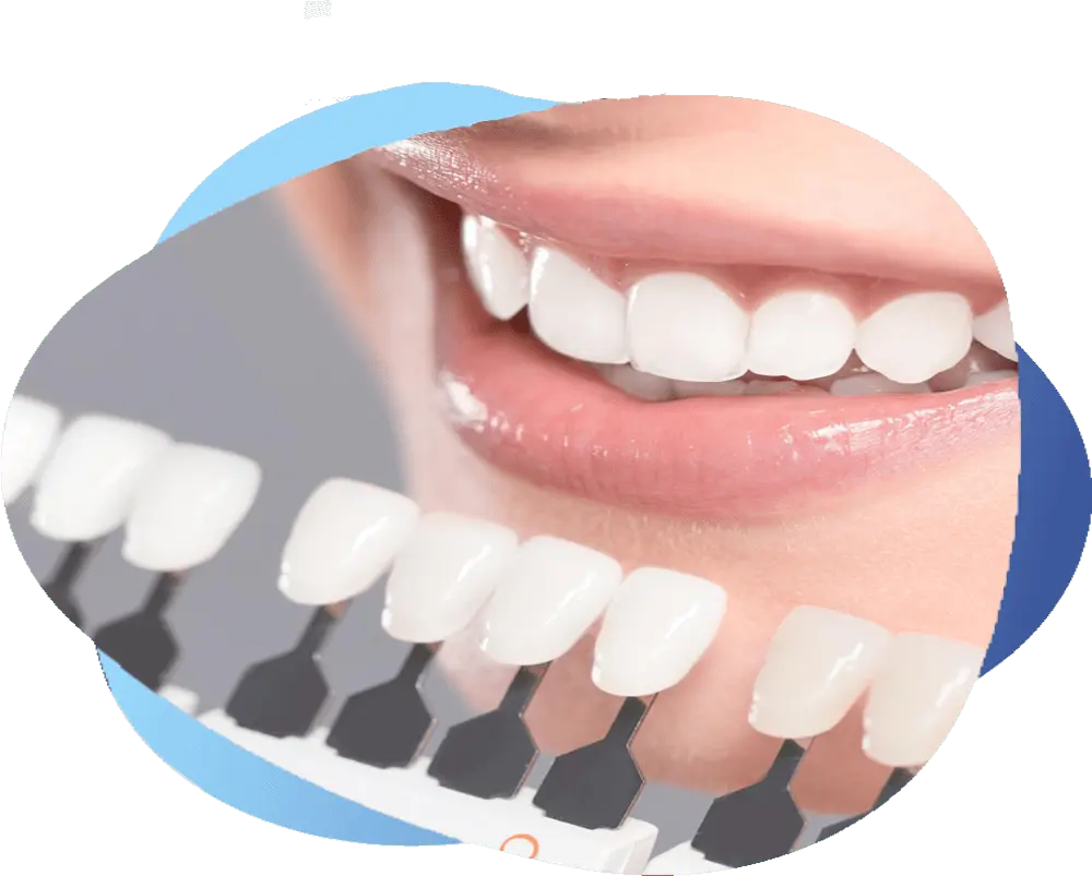 Teeth Filling
