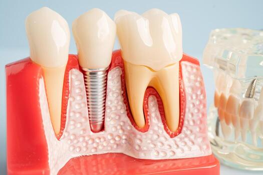 Dental Implants in Islamabad
