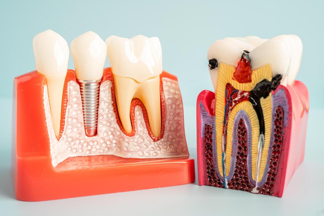 Root canal treatment in Islamabad