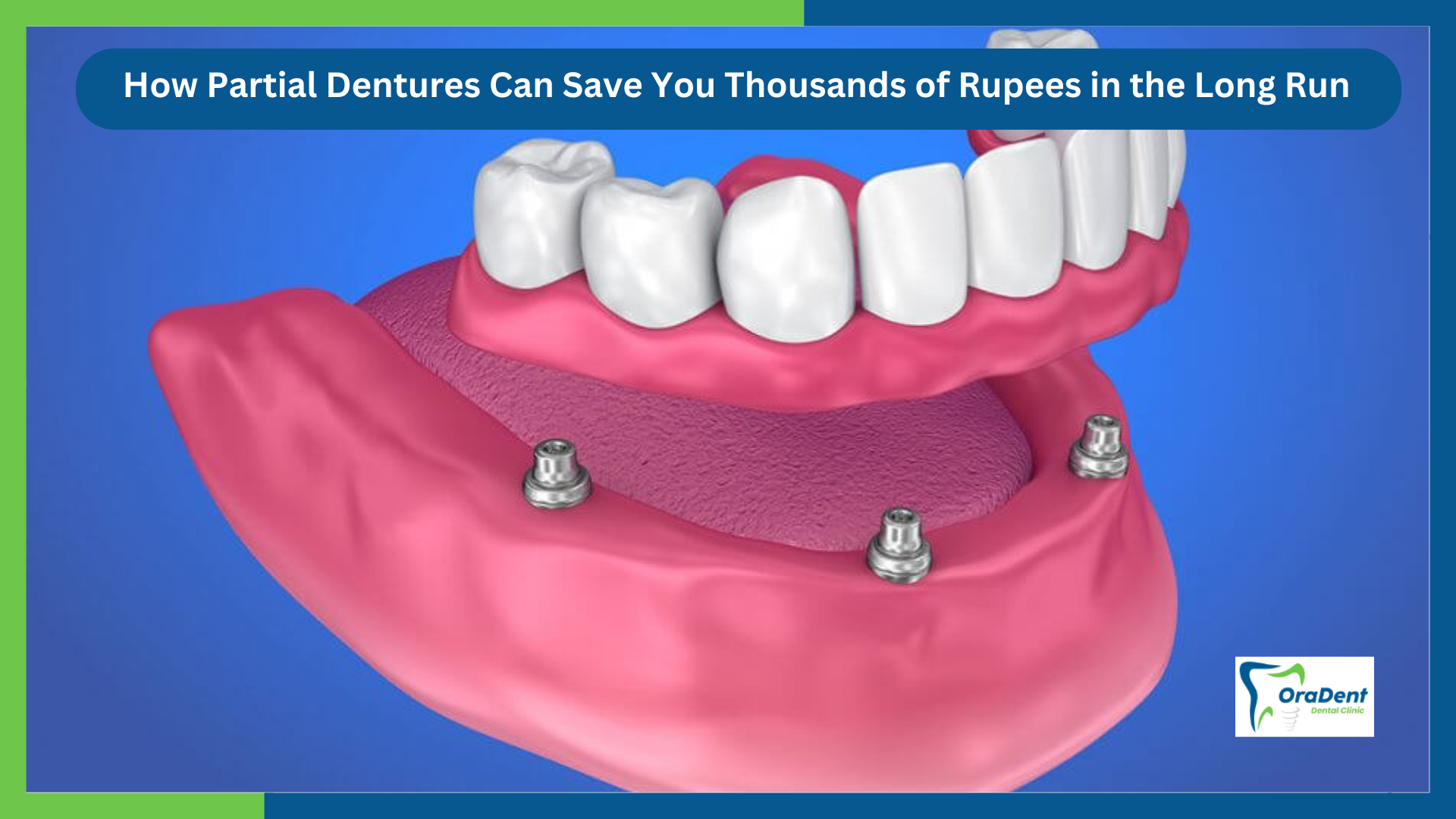 How Partial Dentures Can Save You Thousands of Rupees in the Long Run