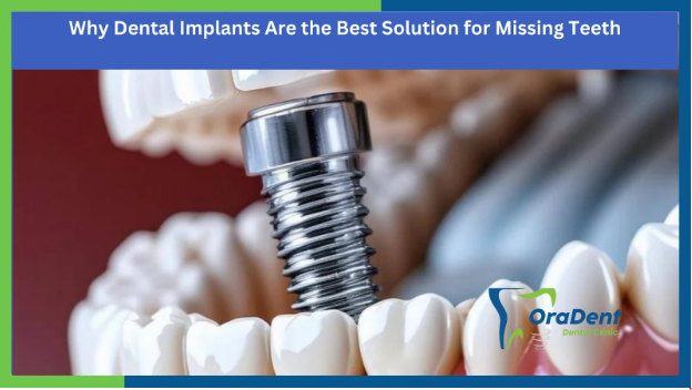 Why Dental Implants Are the Best Solution for Missing Teeth